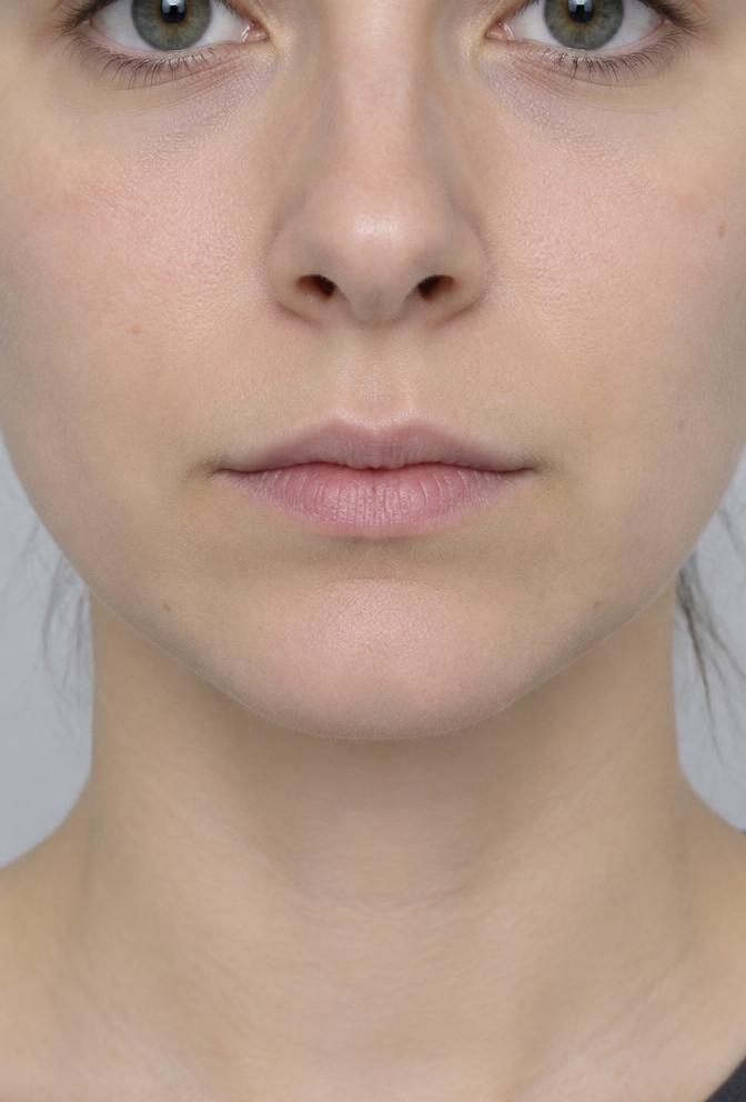 Relleno de labios · caso 1: antes