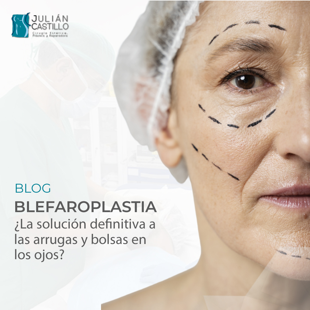 Blefaroplastia: ¿La solución definitiva a las arrugas y bolsas en los ojos?